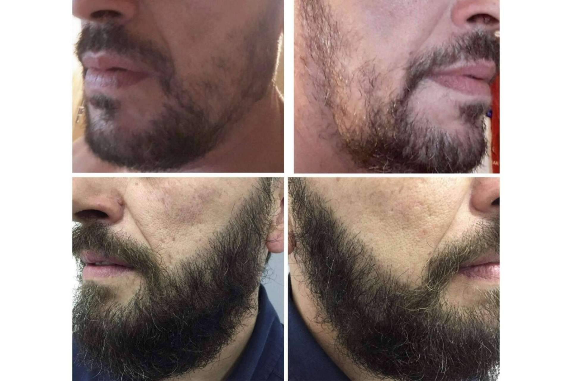 ¿Cuáles son los pasos a seguir en un injerto de barba?, por el Dr. Bruno Jacobovski